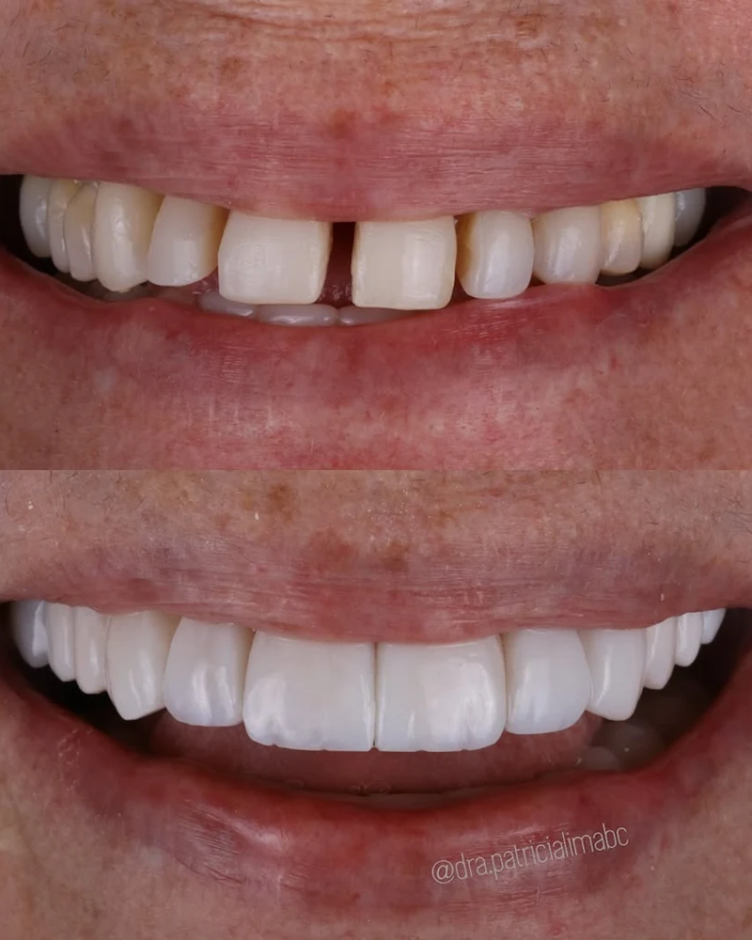 Antes e Depois 5